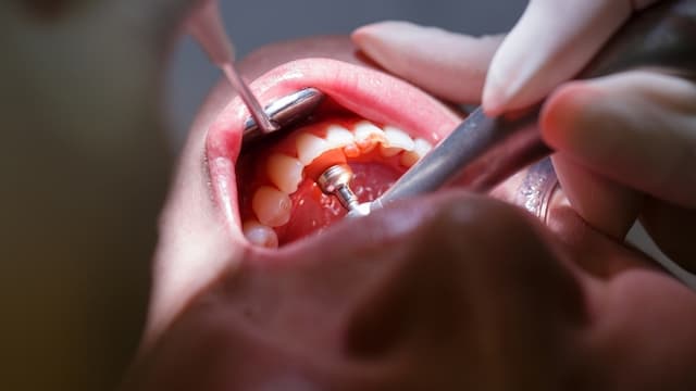 Kista Gigi, Masalah Mulut yang Muncul Akibat Gigi Berlubang